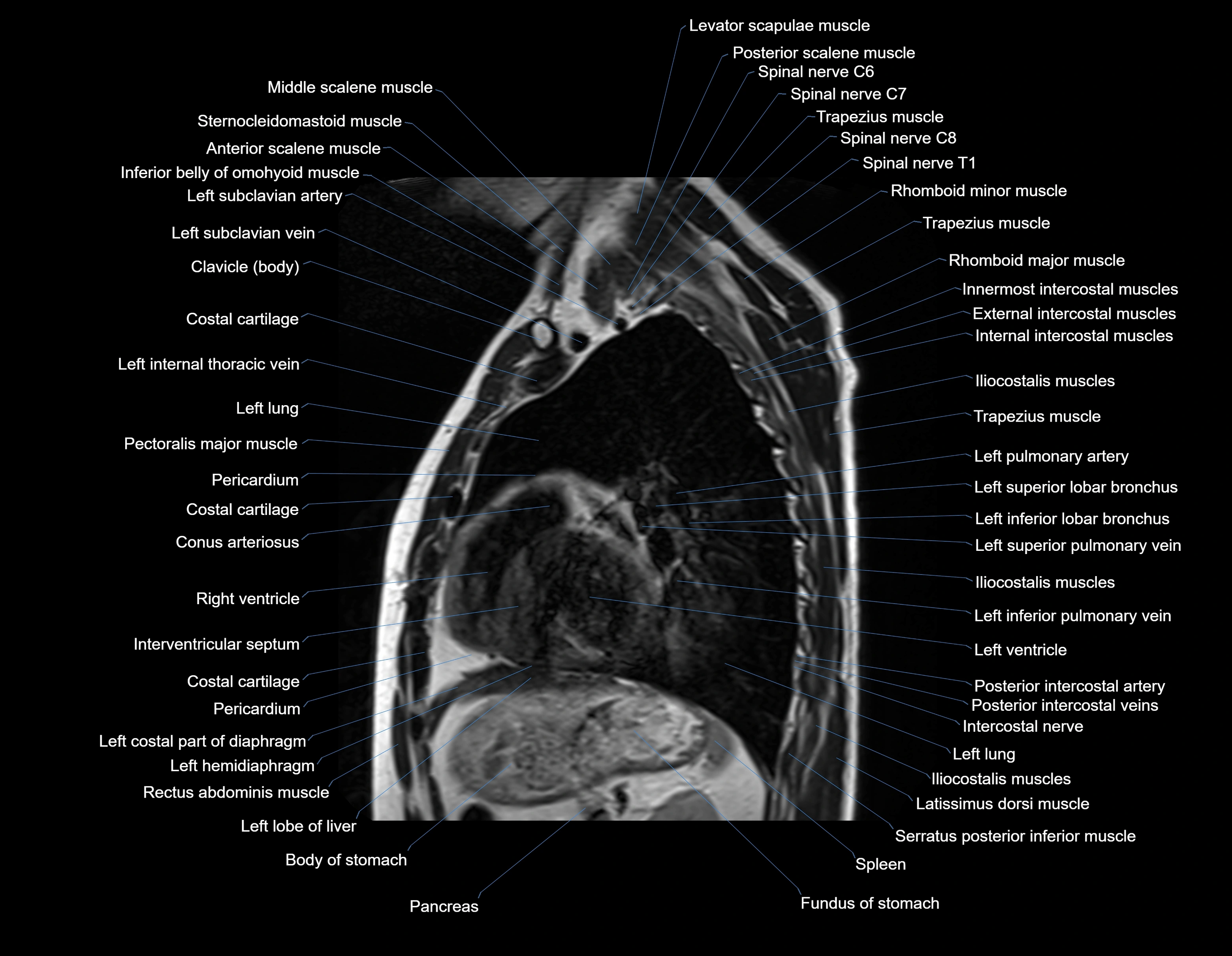 MRI chest (thorax) sagittal labelled cross sectional anatomy 3T radiology image-img-00001-00025.webp
